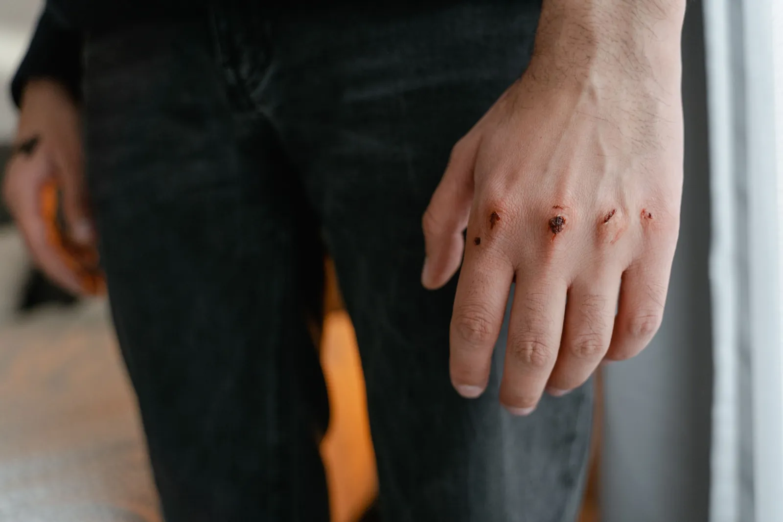 Close-up of a person's hand with wounds and scratches from a dog bite injury